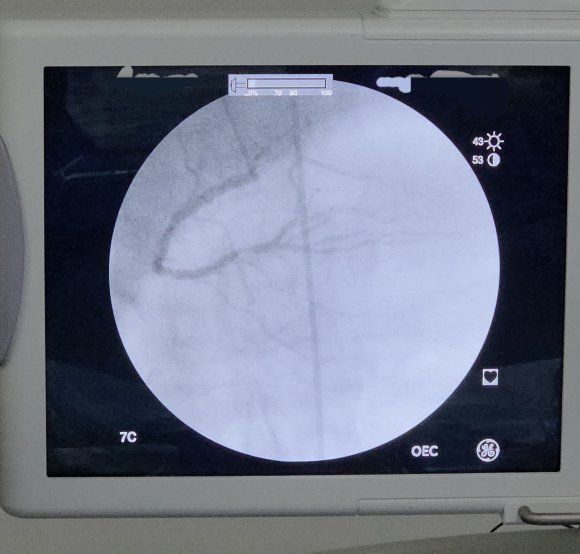 Angiografía coronaria derecha con lesion 