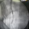 Escopia de un ureter renal con obtruccion proximal