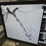 Estenosis de la vena porta tratada con un stent 