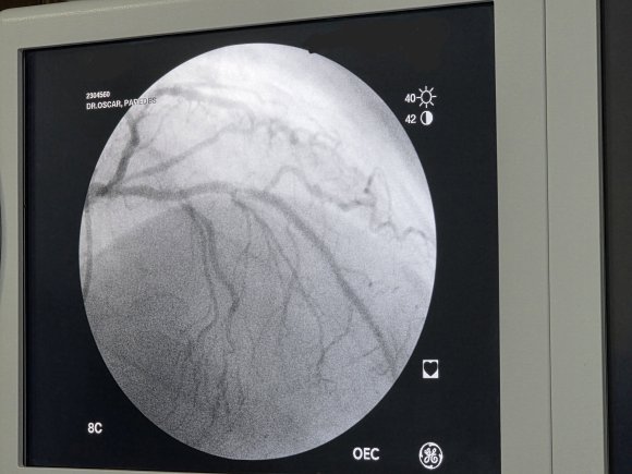 Desendente anterior con varias lesiones severas 