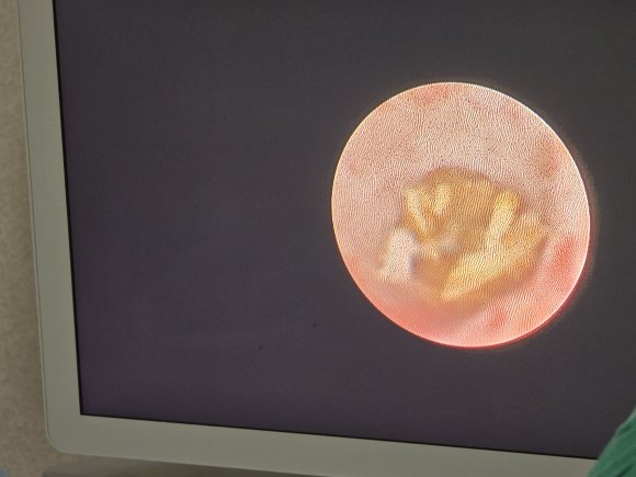 Piedra o calculo en ureter