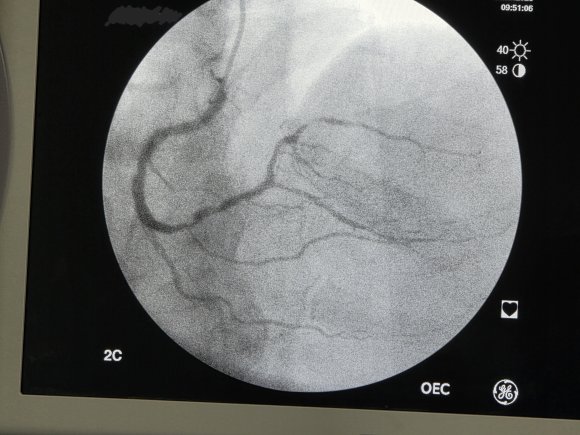 Coronaria derecha con lesion severa