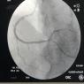 Coronaria derecha con stent