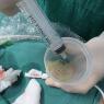 Absceso abdominal 
